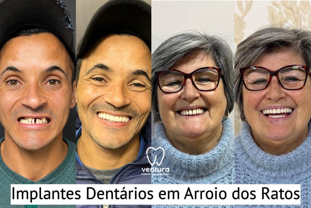 Implante Dentário Arroio dos Ratos antes e depois