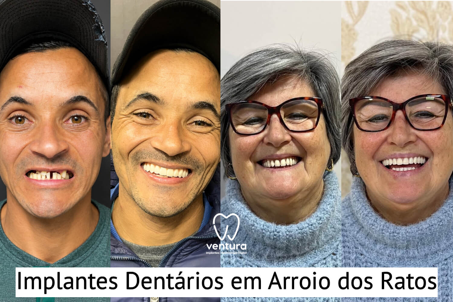 Implante Dentário Arroio dos Ratos antes e depois