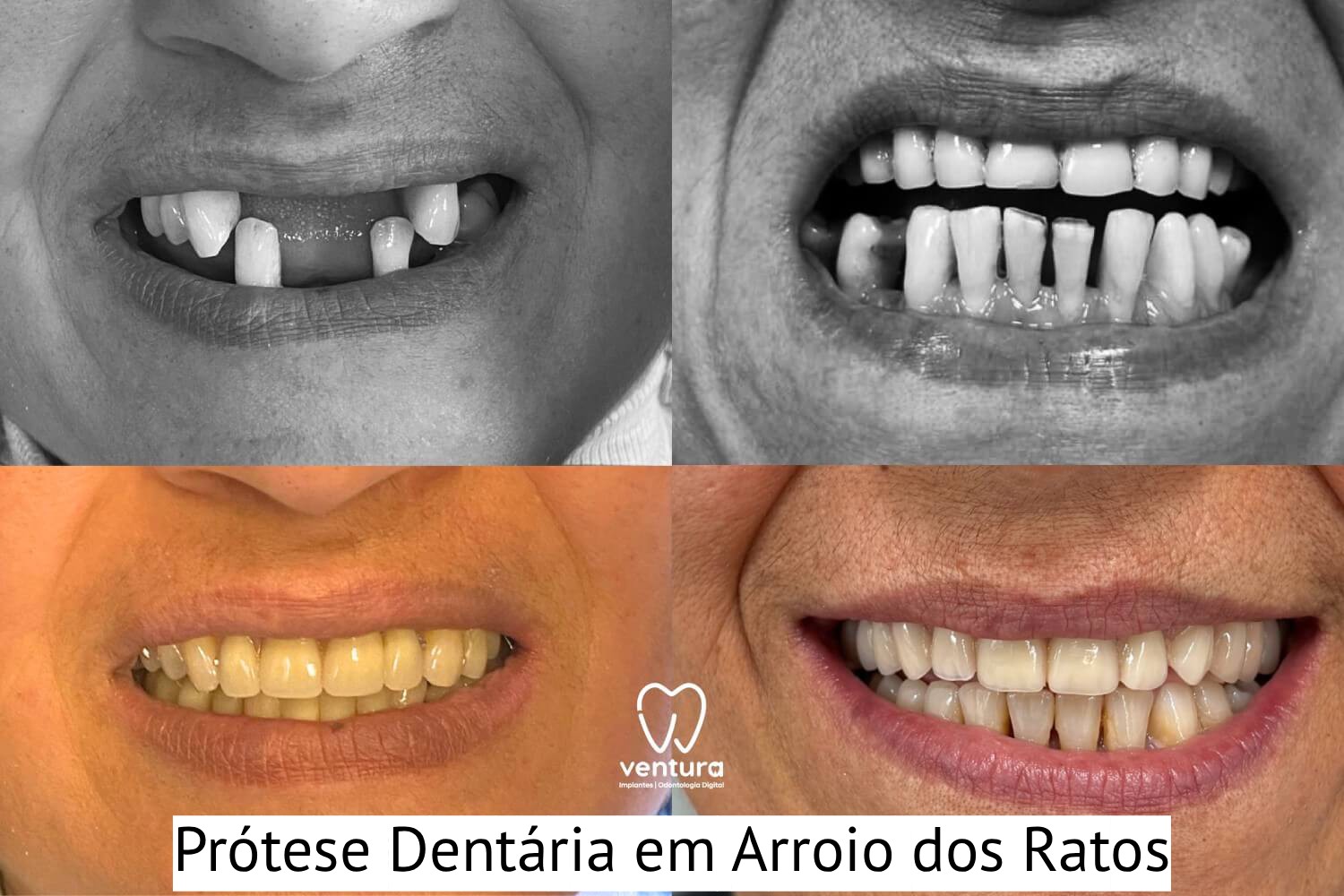 Prótese Protocolo Arroio dos Ratos antes e depois